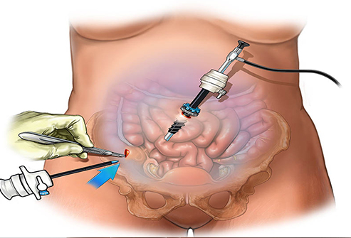 Gynecology